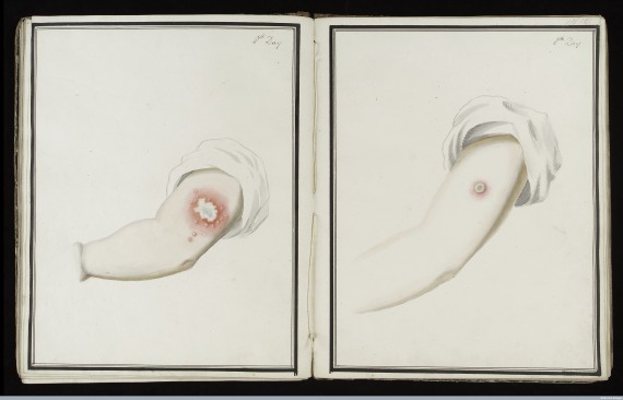 L0039165 Smallpox (left) & cowpox inoculation, day 8
