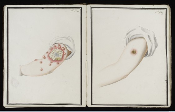 L0039171 Smallpox (left) & cowpox inoculation, day 14